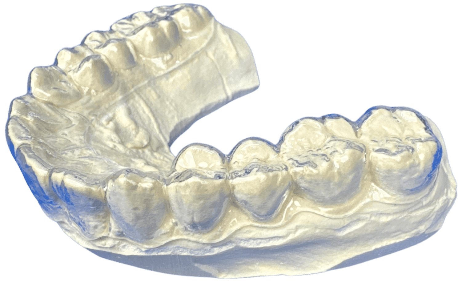 Hàm duy trì trong suốt do Viet Dental Lab sản xuất