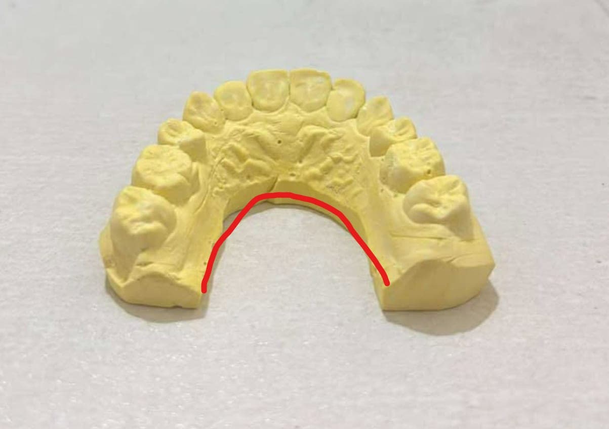 Mẫu hàm duy trì được chuẩn bị tại Viet Dental Lab